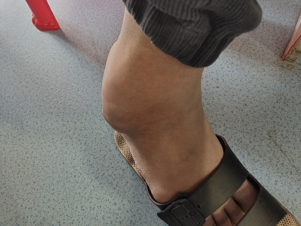 怎样来区别原发性痛风与继发性痛风?